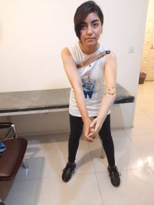 نمونه کار کلینیک پایار (پروتز بالای آرنج از شانه)